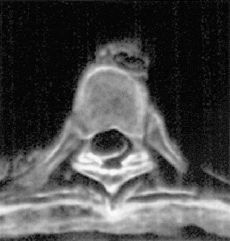 atheromatous aorta in tagalog